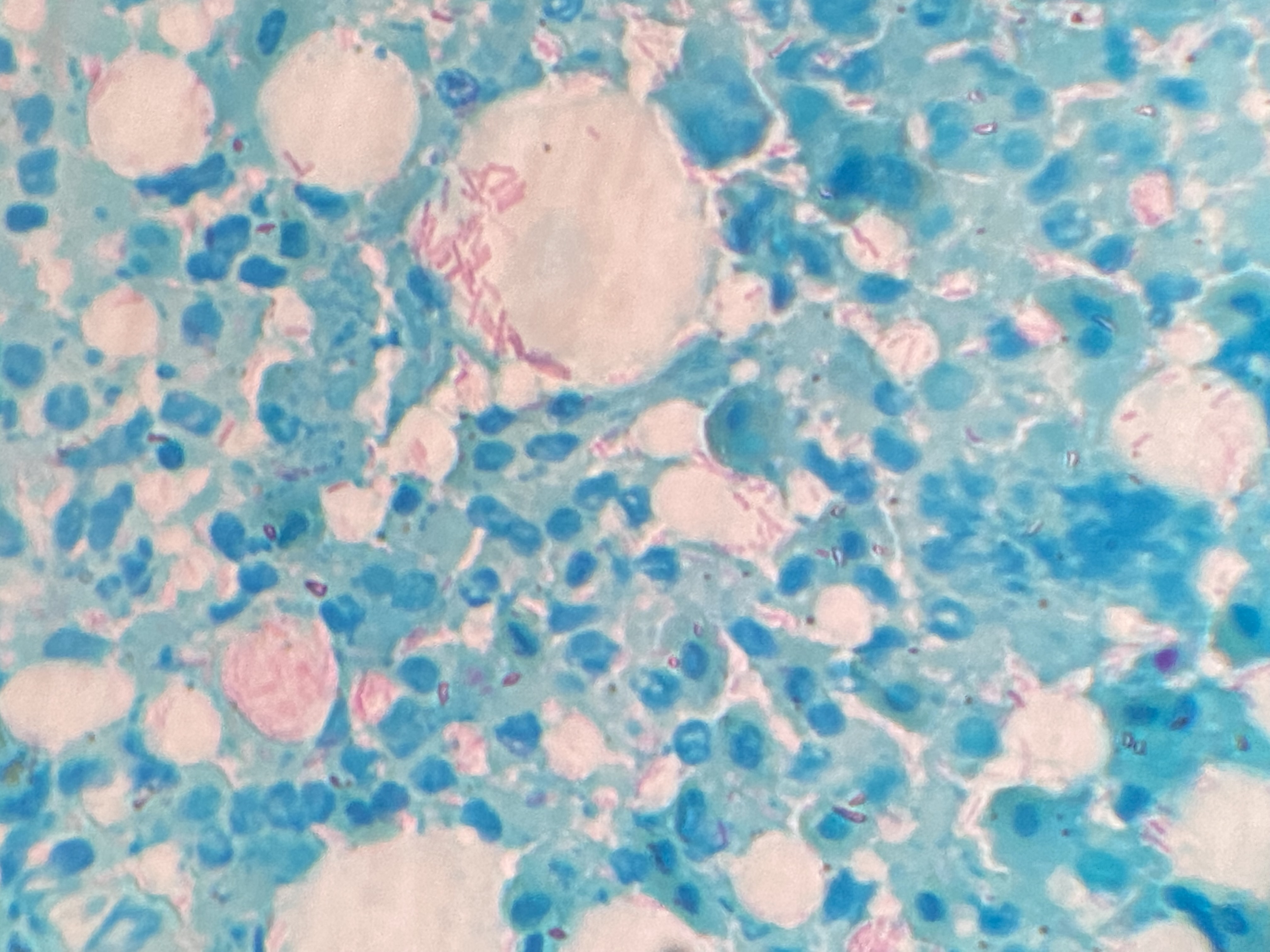 Mycobacteriosis