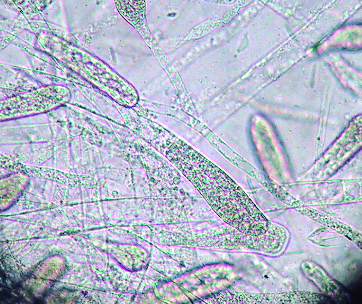 Saproglegniasis