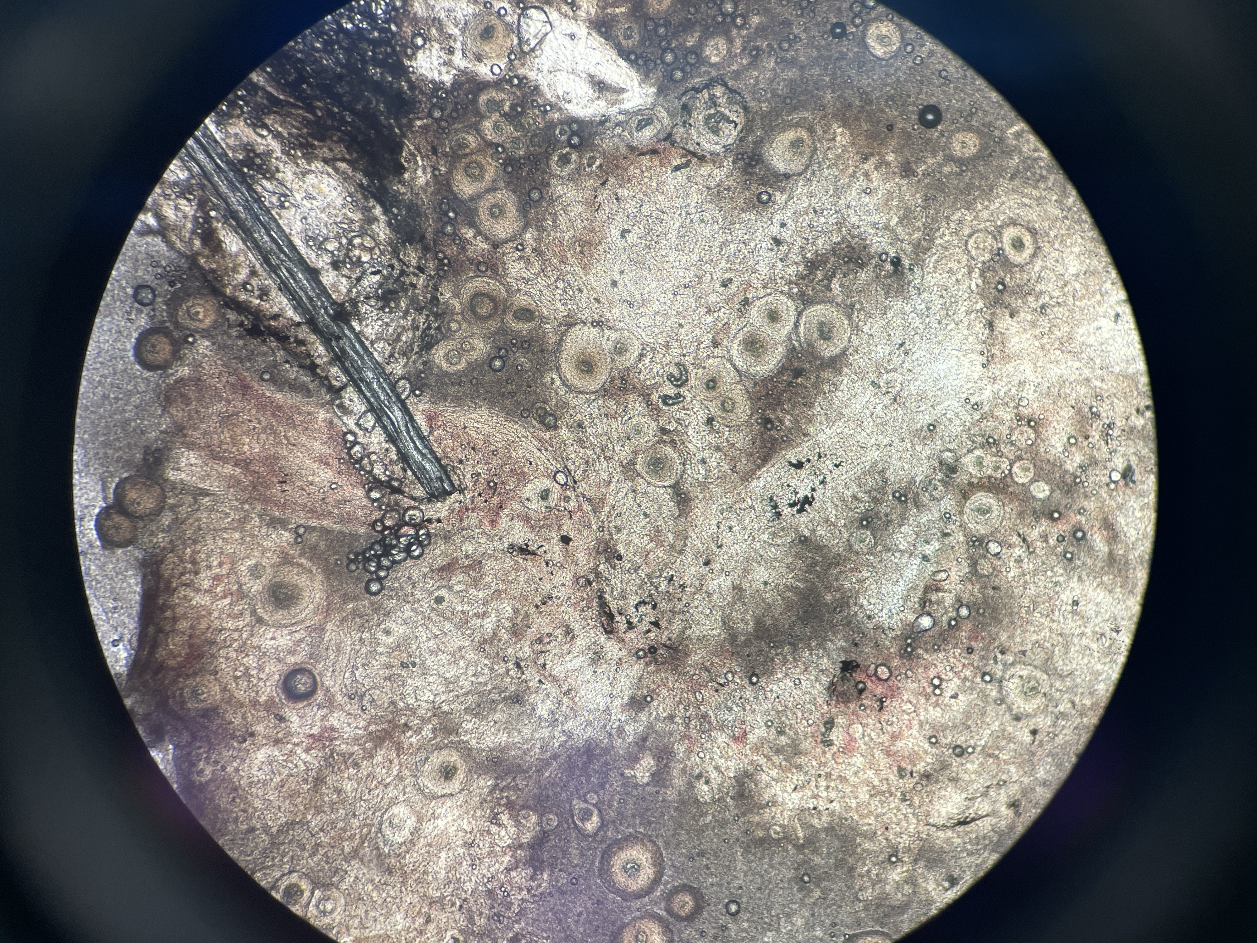 Systemic Granulomas