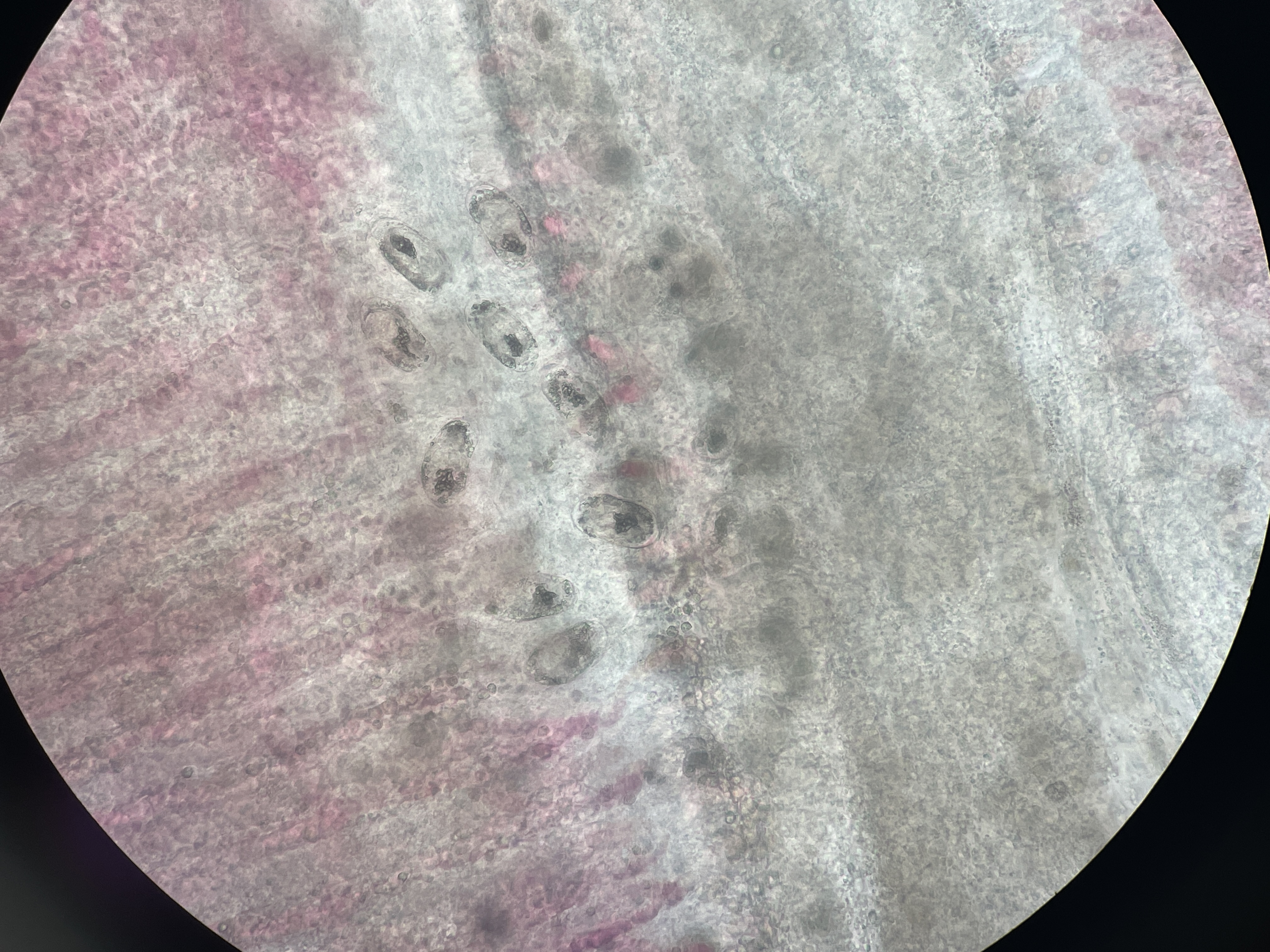 Trematode Digenean Parasitosis