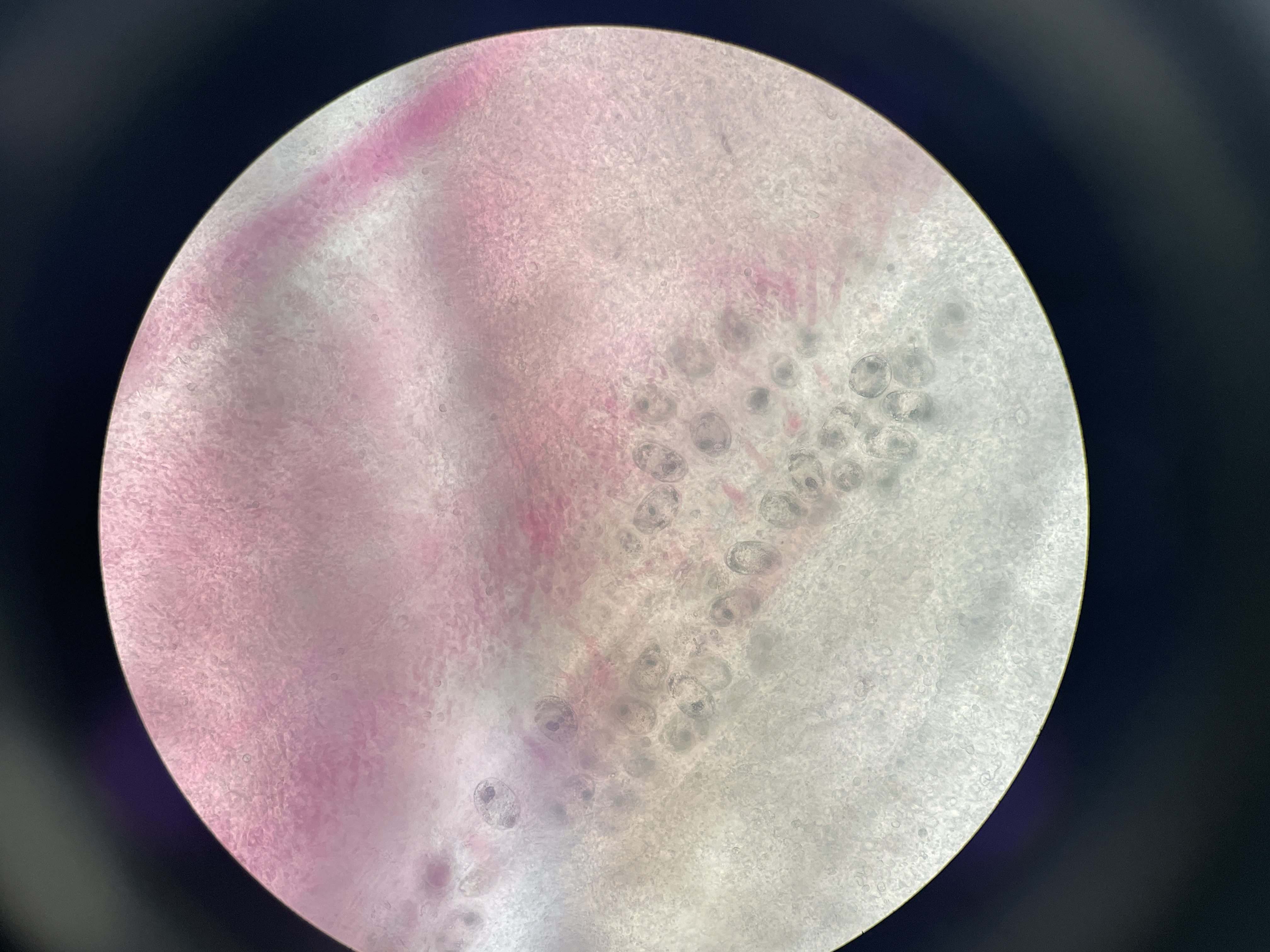 Trematode Digenean Parasitosis